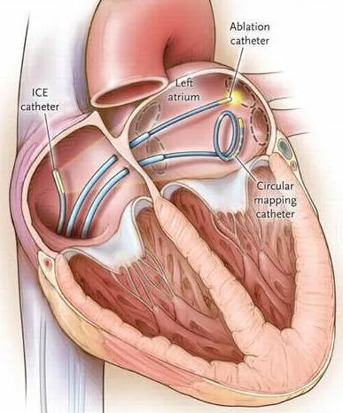 Ablation Catheter