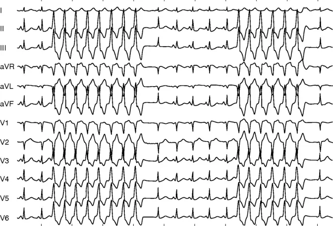 ECG VT