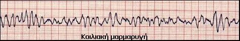 ECG VF