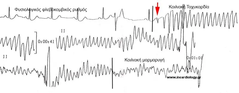 ECG Evolution