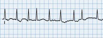 AFib ECG