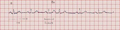 ECG: Atrial Extrasystole