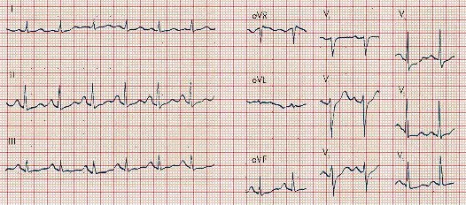 ECG Sinus Tachycardia