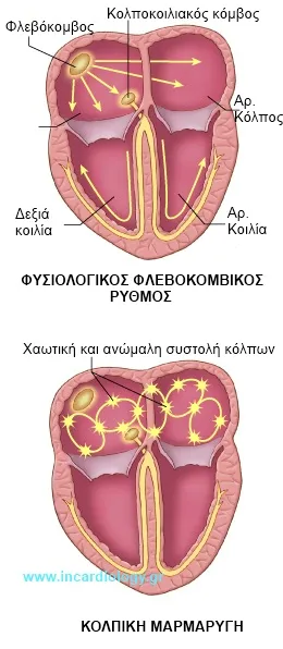 Atrial Fibrillation Mechanism