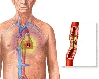 Στεφανιαία Νόσος