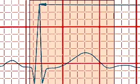 QT Interval