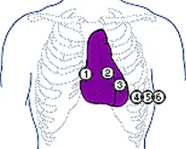 Τοποθέτηση ηλεκτροδίων